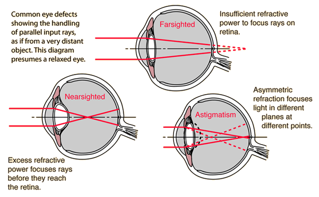 Myopia eye diagram, Rövidlátás (myopia) • kordonoszlop.hu