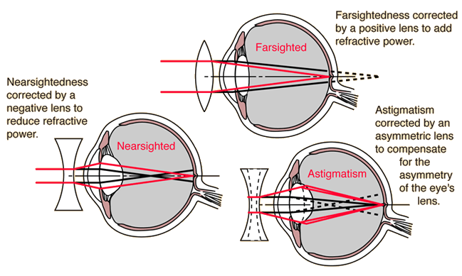 corrected nearsighted vision