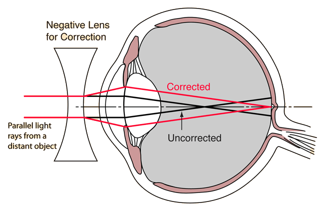 myopia correction diagram)