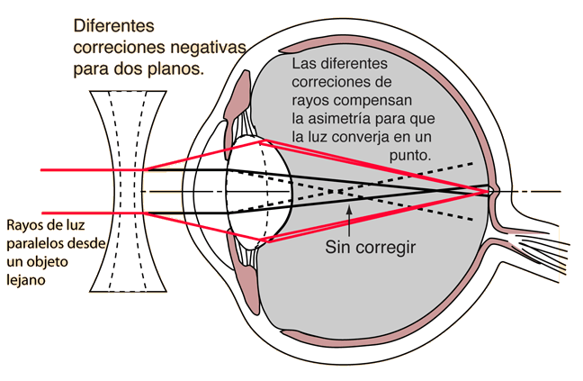 diagrama miopiei