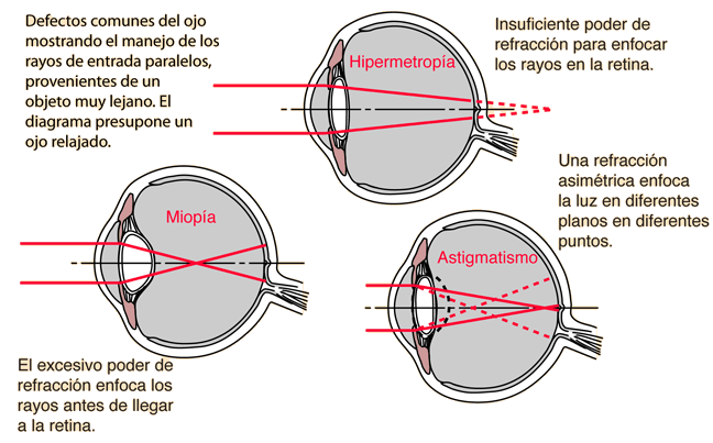 miopie și hipermetropie astigmatism