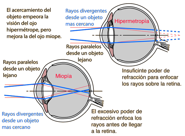 miopía e hipermetropía lentes